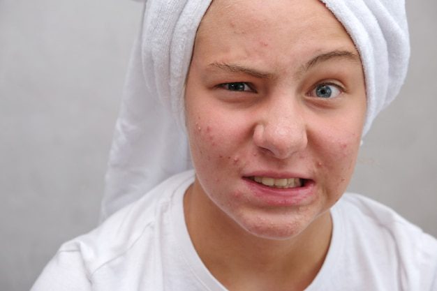 أنواع حب الشباب بالصور